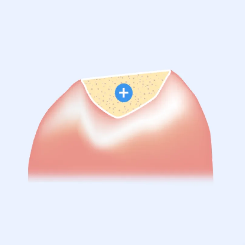 잇몸뼈 이식